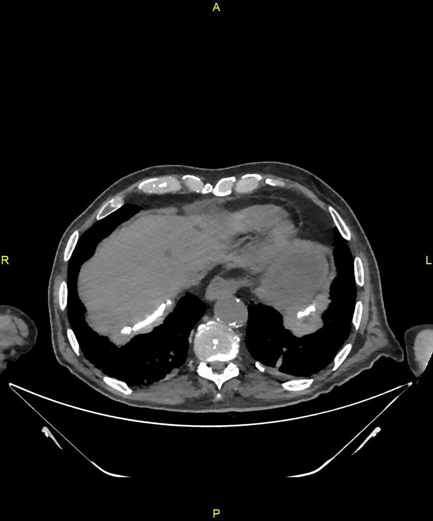 Aortoenteric fistula (Radiopaedia 84308-99603 Axial non-contrast 19).jpg