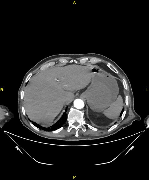 File:Aortoenteric fistula (Radiopaedia 84308-99603 B 42).jpg