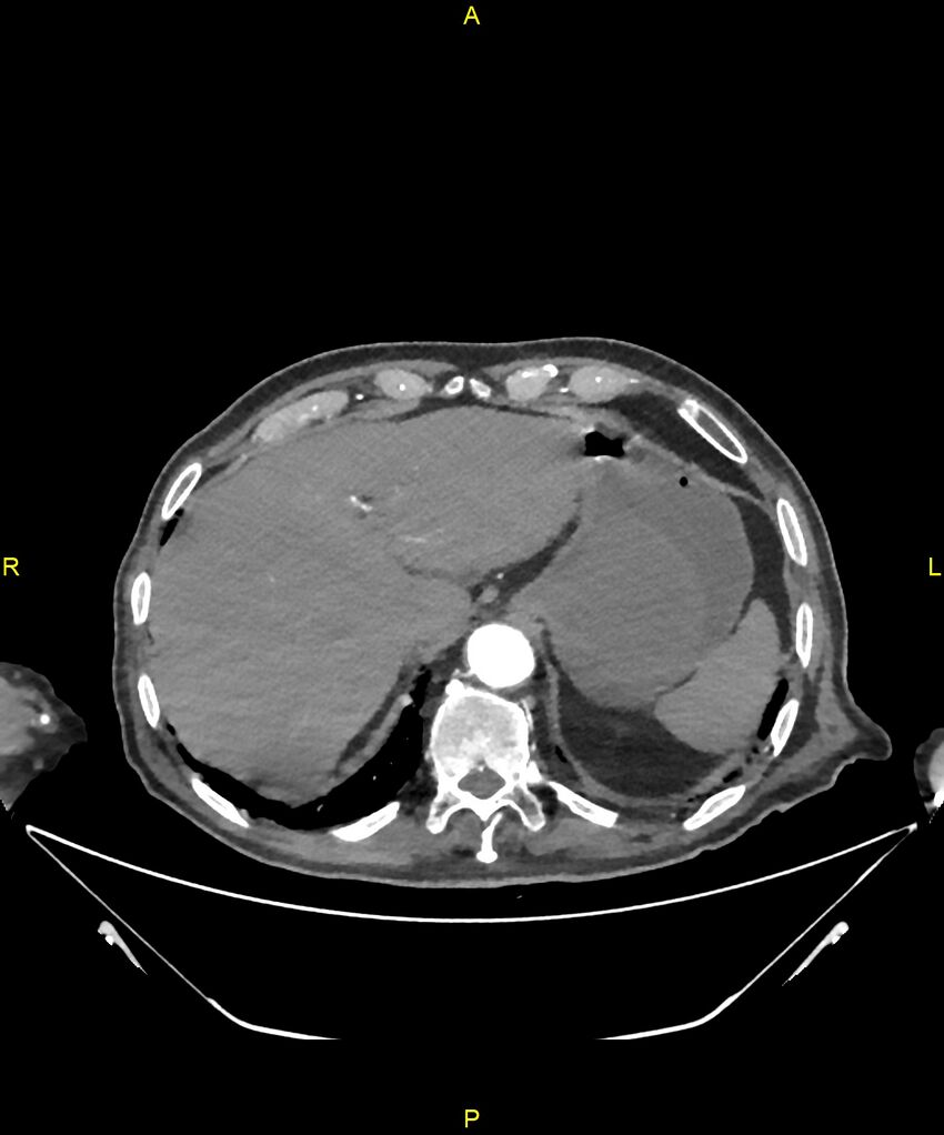 Aortoenteric fistula (Radiopaedia 84308-99603 B 42).jpg