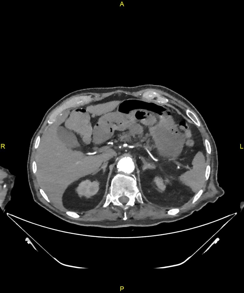 Aortoenteric fistula (Radiopaedia 84308-99603 B 70).jpg