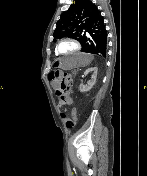 File:Aortoenteric fistula (Radiopaedia 84308-99603 C 250).jpg