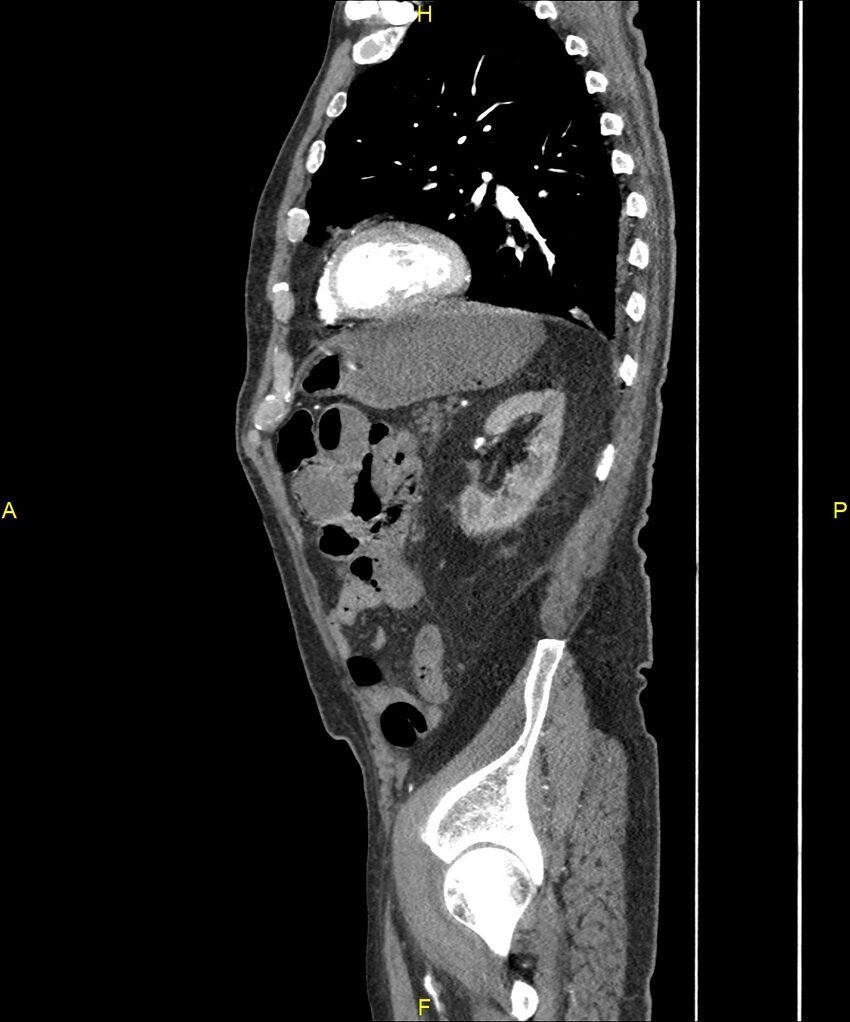 Aortoenteric fistula (Radiopaedia 84308-99603 C 250).jpg