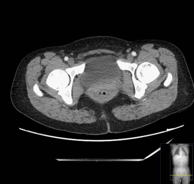 File:Appendicitis (CT angiogram) (Radiopaedia 154713-127660 Axial 76).jpg