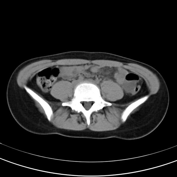 File:Appendicitis and incidental bicornuate uterus (Radiopaedia 22833-22853 Axial non-contrast 29).jpg