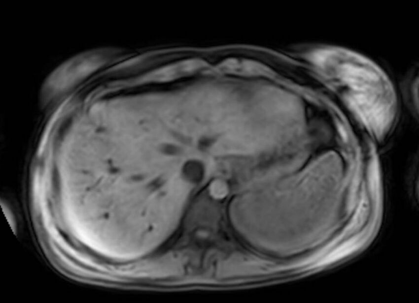 Appendicitis in gravida (MRI) (Radiopaedia 89433-106395 Axial DIXON 9).jpg