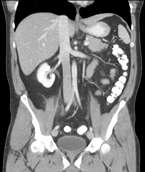 File:Appendicitis with cecal bar sign (Radiopaedia 31878-32830 A 33).jpg