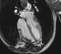 Arrhythmogenic right ventricular cardiomyopathy (Radiopaedia 39806-42237 D 55).jpg