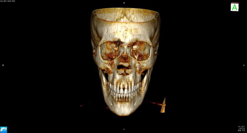 File:Arrow injury to the brain (Radiopaedia 72101-82607 3D bone 4).jpg