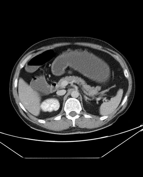 File:Arterial occlusive mesenteric ischemia (Radiopaedia 84641-100054 A 38).jpg