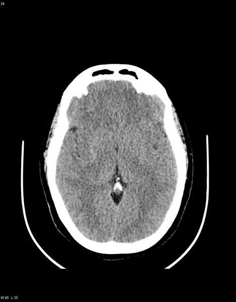 File:Astroblastoma (Radiopaedia 39792-42216 Axial non-contrast 23).jpg
