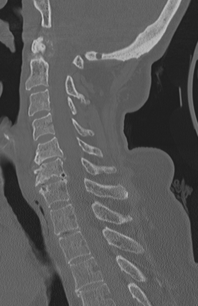File:Atlanto-axial subluxation (Radiopaedia 36610-38176 Sagittal bone window 44).png