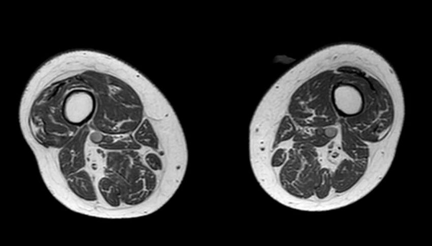 Atypical lipomatous tumor - thigh (Radiopaedia 68975-78734 Axial T1 33).jpg