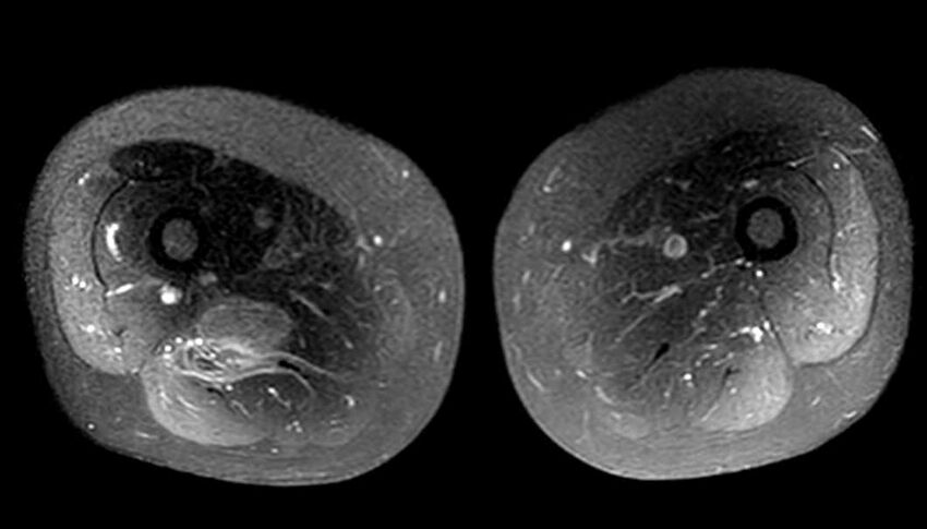 Atypical lipomatous tumor - thigh (Radiopaedia 68975-78734 Axial T1 C+ fat sat 52).jpg