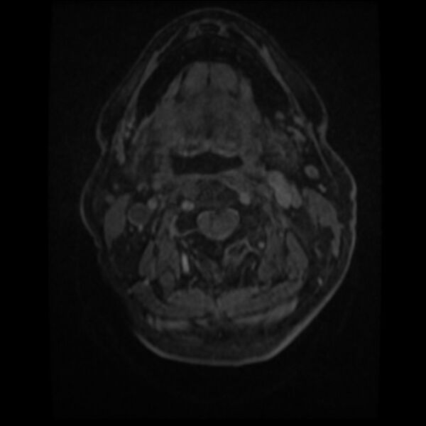 File:Atypical meningioma (Radiopaedia 45535-49629 Axial T1 C+ 1).jpg