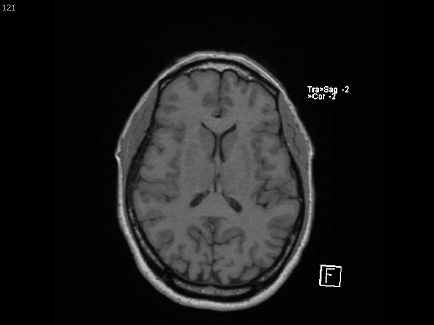 Atypical meningioma - intraosseous (Radiopaedia 64915-74572 Axial T1 121).jpg