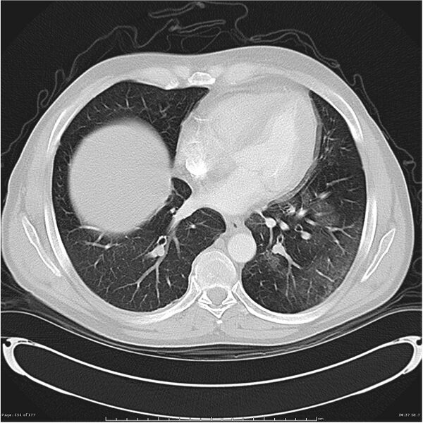File:Atypical pneumonia - Q fever (Radiopaedia 21993-21989 lung window 30).jpg