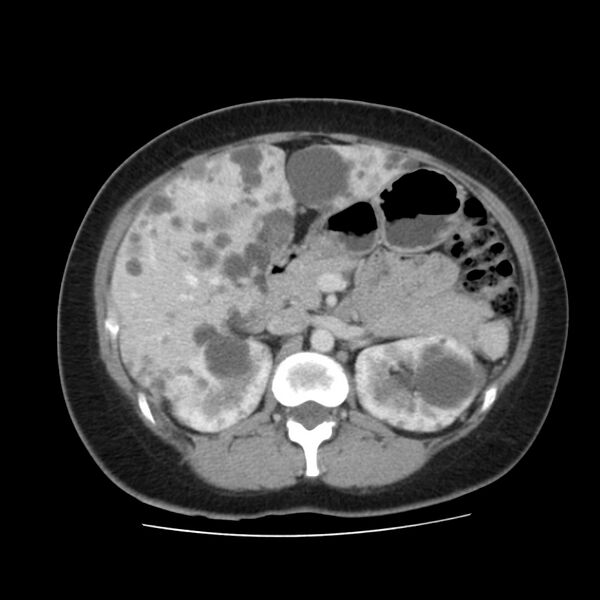 File:Autosomal dominant polycystic kidney disease (Radiopaedia 23061-23093 C 23).jpg