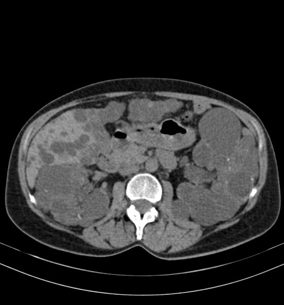 File:Autosomal dominant polycystic kidney disease (Radiopaedia 41918-44922 Axial non-contrast 13).jpg