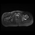 Avascular necrosis of the hip (Radiopaedia 29563-30067 Axial T2 fat sat 11).jpg