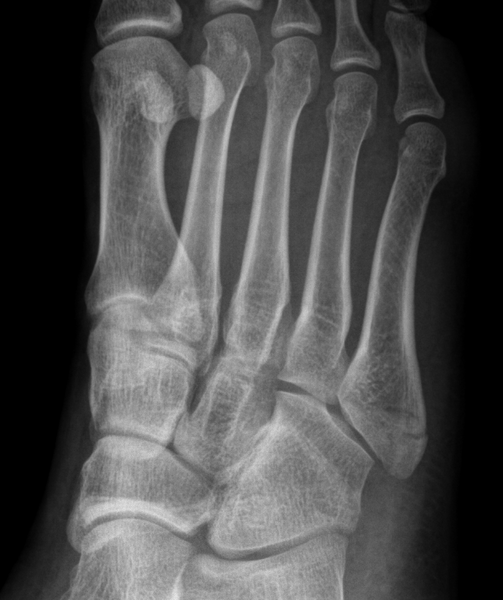 File:Avulsion fracture of the 5th metatarsal styloid - pseudo-Jones fracture (Radiopaedia 63079-71569 Oblique - zoomed 1).PNG