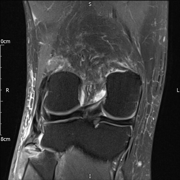 File:Avulsion fracture of the fibular head (Radiopaedia 74804-85808 Coronal PD fat sat 25).jpg