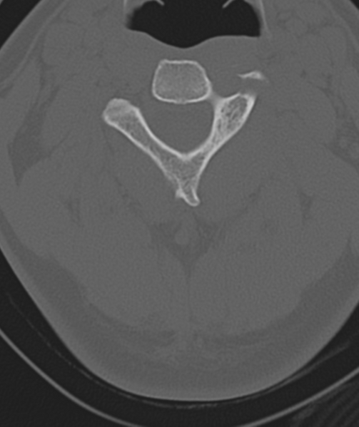 File:Axis peg fracture (type 3) and atlas lateral mass (type 4) fracture (Radiopaedia 37474-39324 Axial bone window 21).png