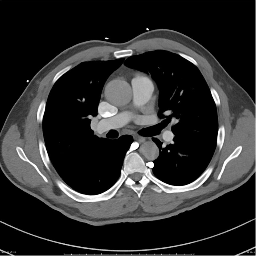 Azygos venous system anatomy (CT pulmonary angiography) (Radiopaedia 25928-26077 Axial C+ CTPA 40).jpg