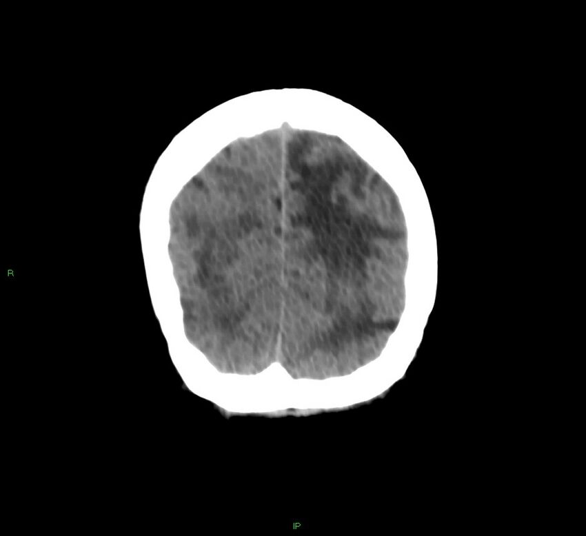 Basal ganglia hemorrhage (Radiopaedia 58766-65988 Coronal non-contrast 14).jpg