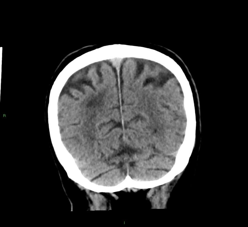 Basal ganglia hemorrhage (Radiopaedia 58791-66025 Coronal non-contrast 15).jpg