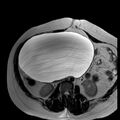 Benign seromucinous cystadenoma of the ovary (Radiopaedia 71065-81300 B 26).jpg