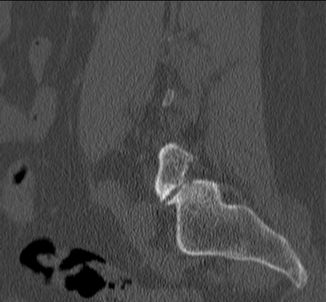 File:Bertolotti syndrome (Radiopaedia 24864-25128 Sagittal bone window 44).jpg