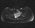Bicornuate bicollis uterus (Radiopaedia 61626-69616 Axial PD fat sat 14).jpg