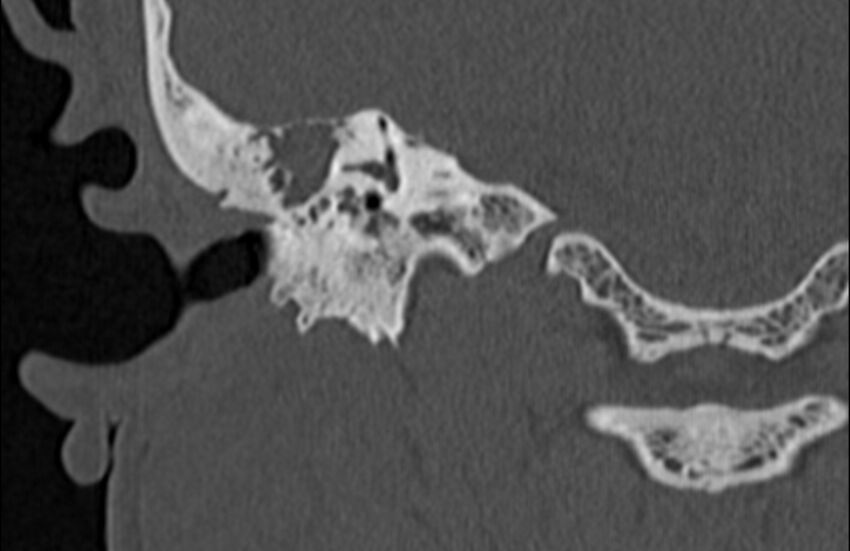 Bilateral cholesteatoma (Radiopaedia 54898-61172 Coronal bone window 47).jpg