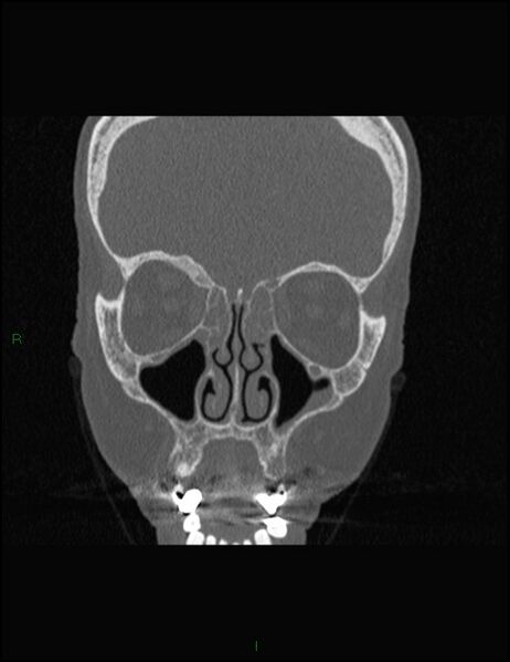 File:Bilateral frontal mucoceles (Radiopaedia 82352-96454 Coronal 128).jpg