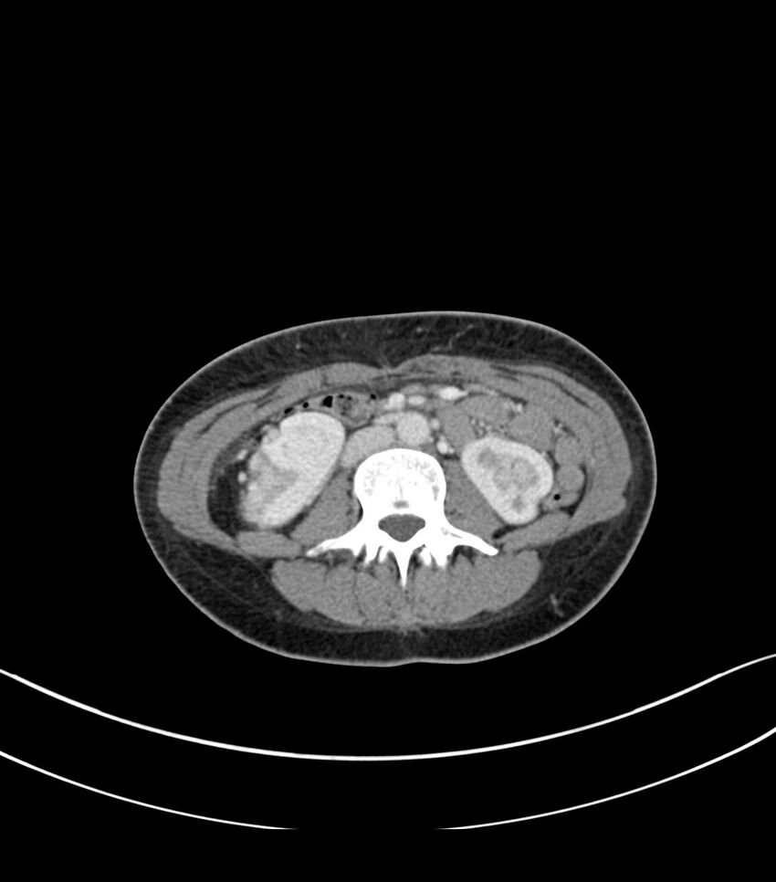 Bilateral kidney malrotation (Radiopaedia 72227-82749 A 30).jpg