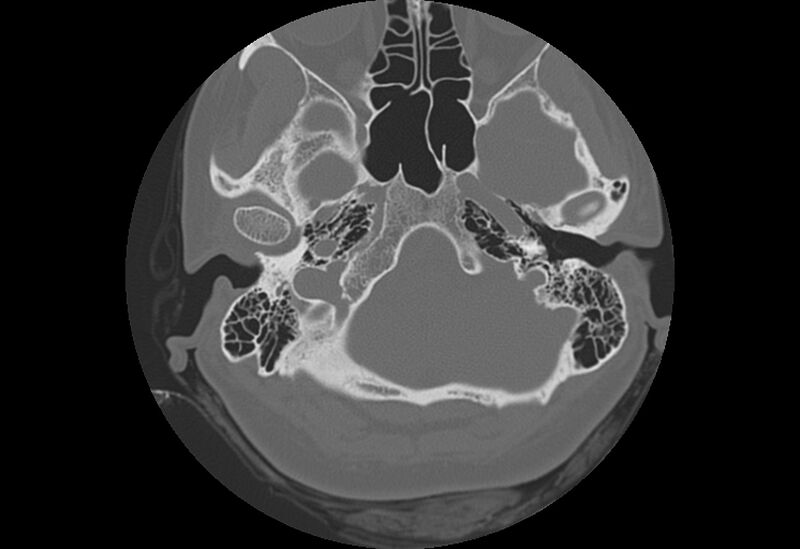 File:Bilateral otospongiosis (Radiopaedia 35447-36940 Axial bone window 16).jpg