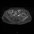Bilateral ovarian fibroma (Radiopaedia 44568-48293 Axial T1 C+ fat sat 4).jpg