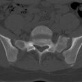 Bilateral pars defect (Radiopaedia 26691-26846 Axial bone window 72).jpg