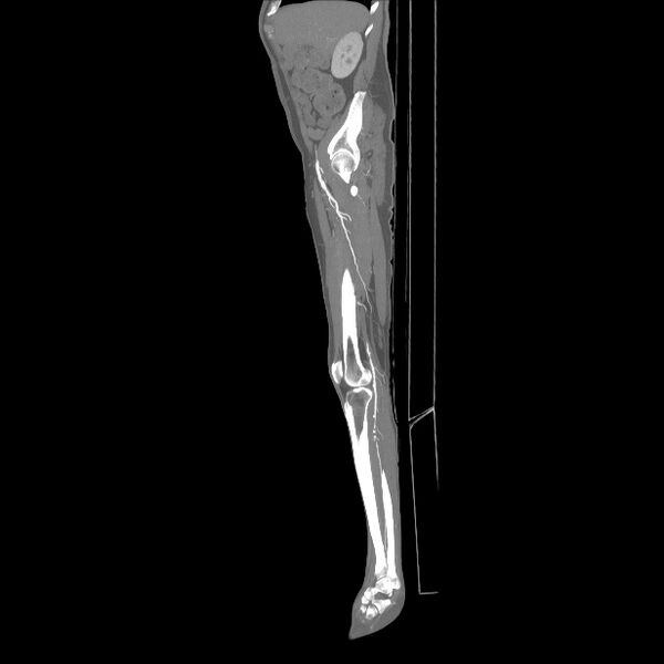File:Bilateral superficial femoral arterial occlusion (Radiopaedia 25682-25857 MIP 10).jpg