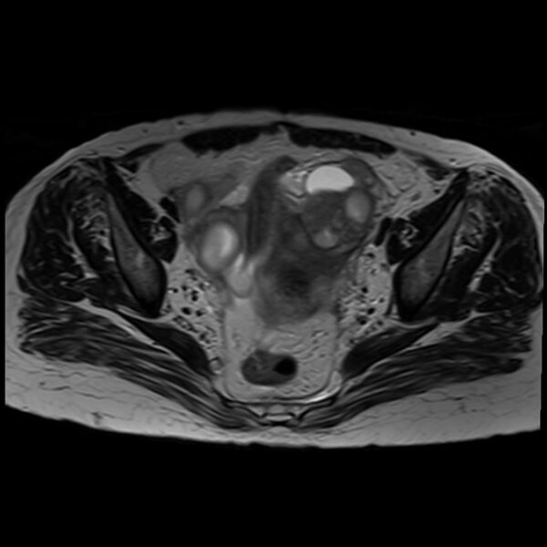 File:Bilateral tubo-ovarian abscesses (Radiopaedia 58635-65829 Axial T2 23).jpg