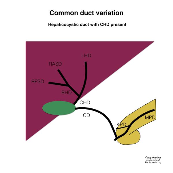 File:Biliary duct anatomic variation (diagram) (Radiopaedia 70380-80479 Common ducts 6).jpeg