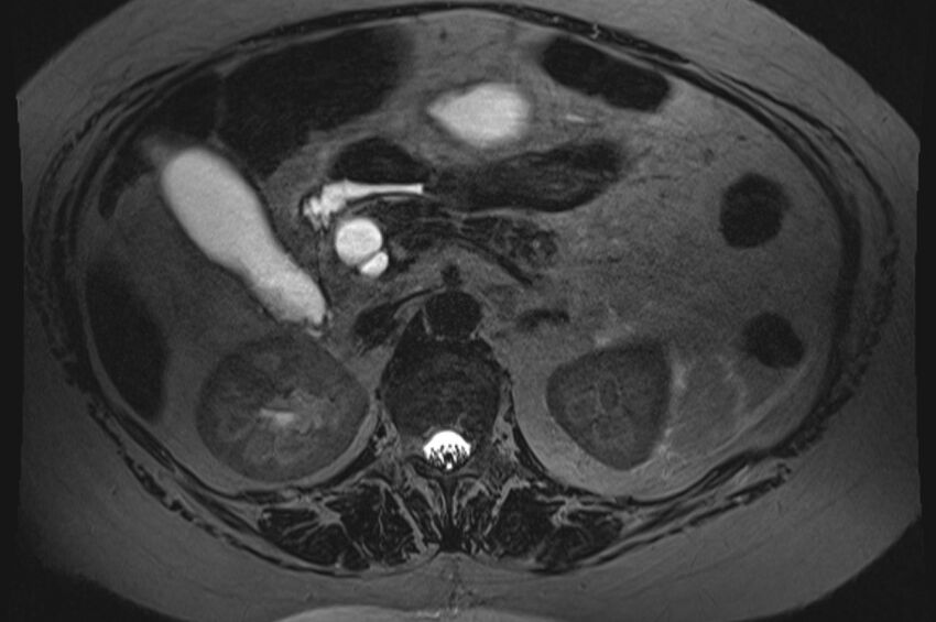 Biliary pancreatitis (Radiopaedia 72289-82824 Axial T2 60).jpg
