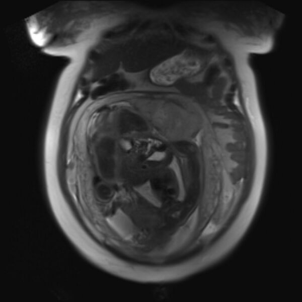 File:Bilobed placenta accreta (Radiopaedia 69648-79591 Coronal T2 12).jpg