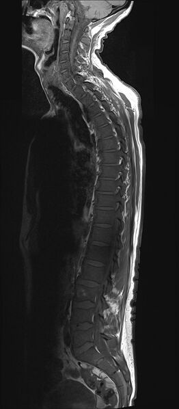 File:Bing-Neel syndrome (Radiopaedia 71453-81799 Sagittal T1 5).jpg