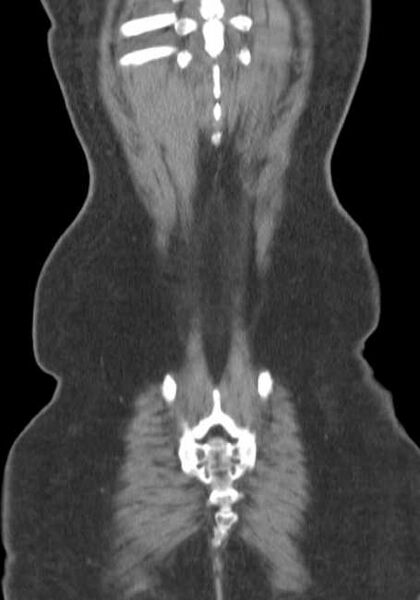 File:Bleeding duodenal ulcer and adenomyomatosis of gallbladder (Radiopaedia 61834-69861 B 6).jpg