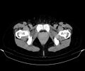 Blind-ending branch of a bifid ureter (Radiopaedia 43613-47034 A 191).jpg