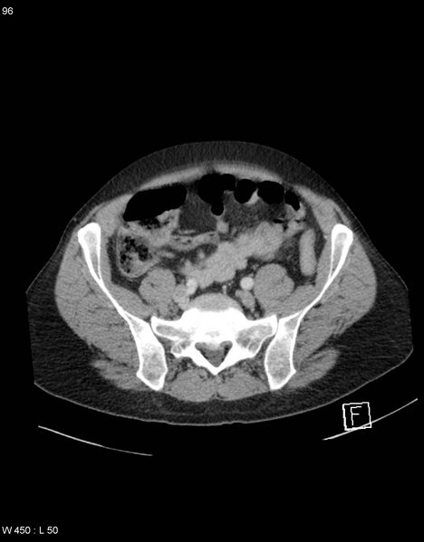 File:Boerhaave syndrome with tension pneumothorax (Radiopaedia 56794-63603 A 48).jpg