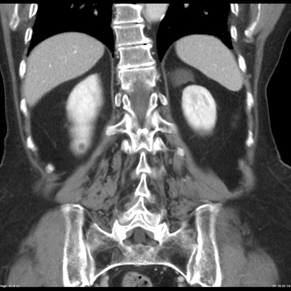 File:Bosniak renal cyst - type IIF (Radiopaedia 23385-23450 B 11).jpg