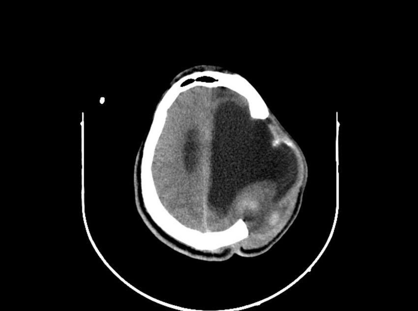 Brain injury by firearm projectile (Radiopaedia 82068-96088 A 162).jpg
