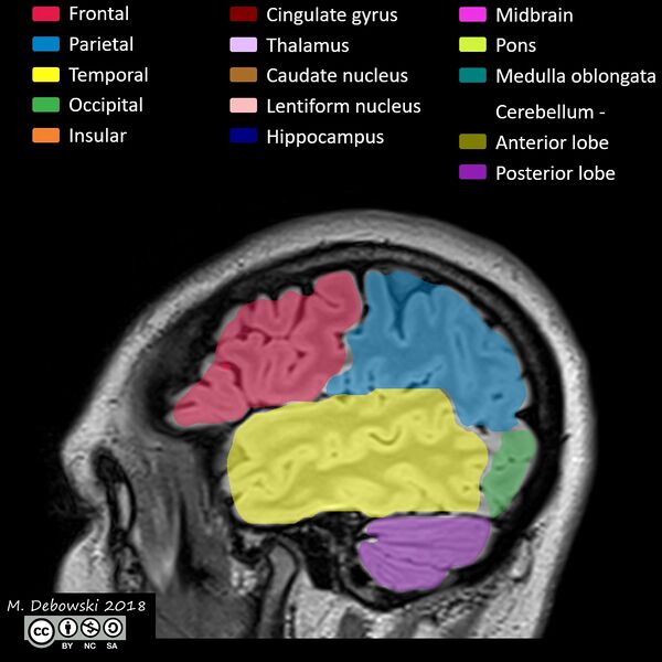 File:Brain lobes - annotated MRI (Radiopaedia 61691-69700 Sagittal 68).JPG